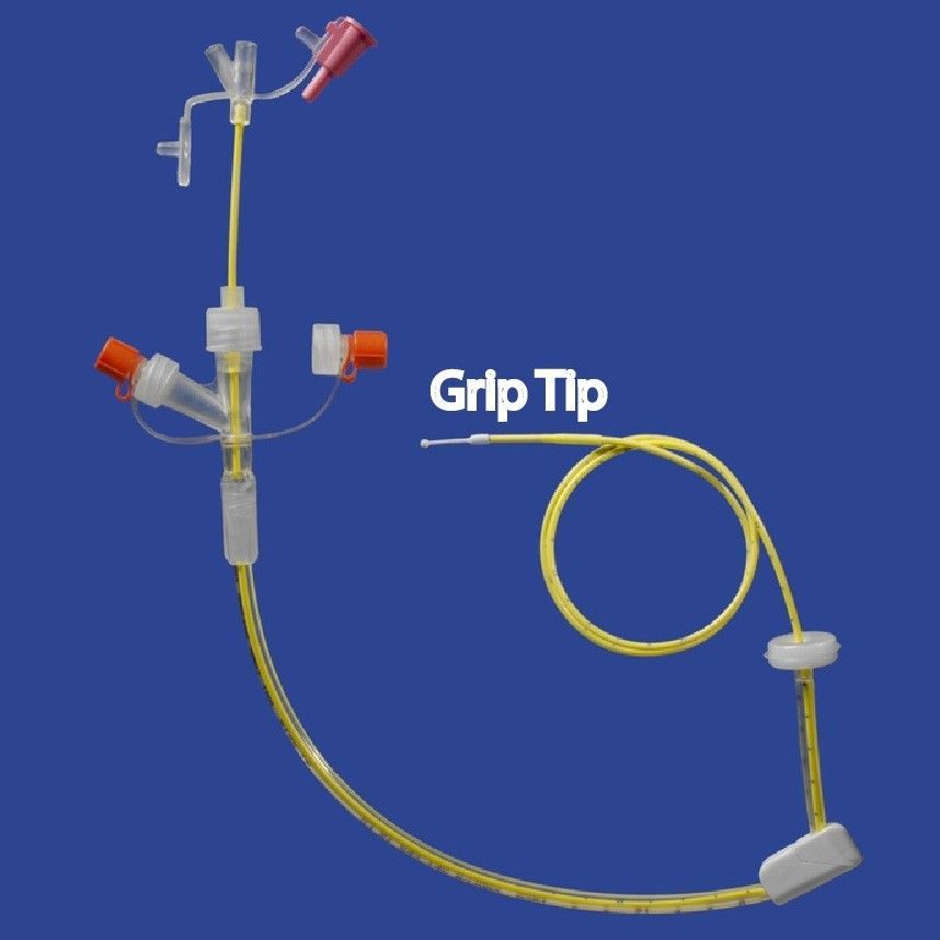 Mila PEG feeding tube